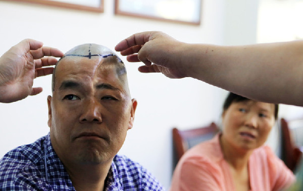 Man accepts a 3D-printed titanium half-skull